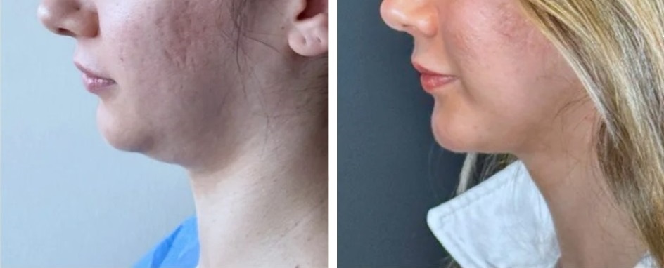 Mentoplastia caso 10 — antes y después